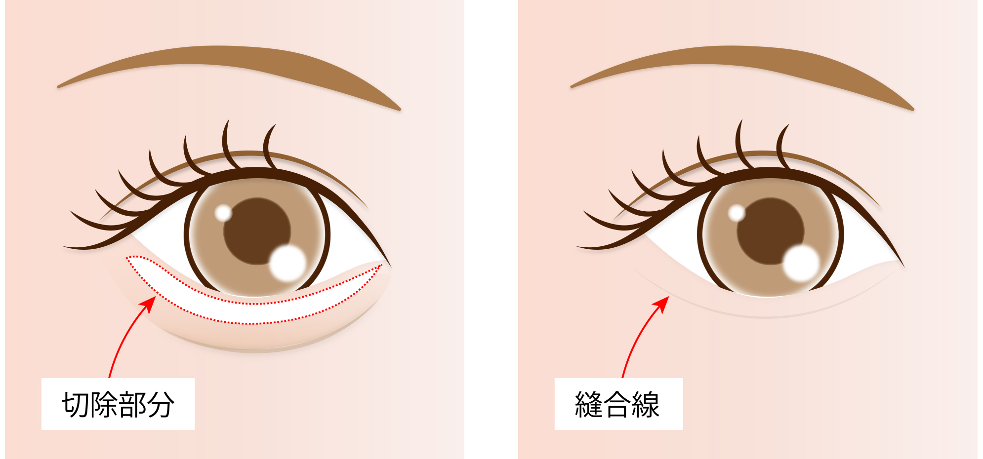 切開法による目の下のたるみ取り（下眼瞼除皺術）