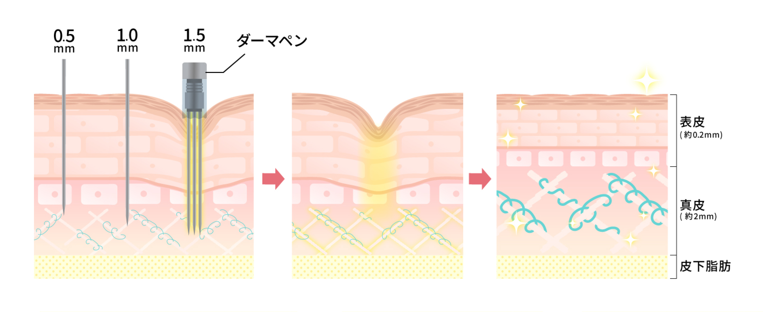 ダーマペン