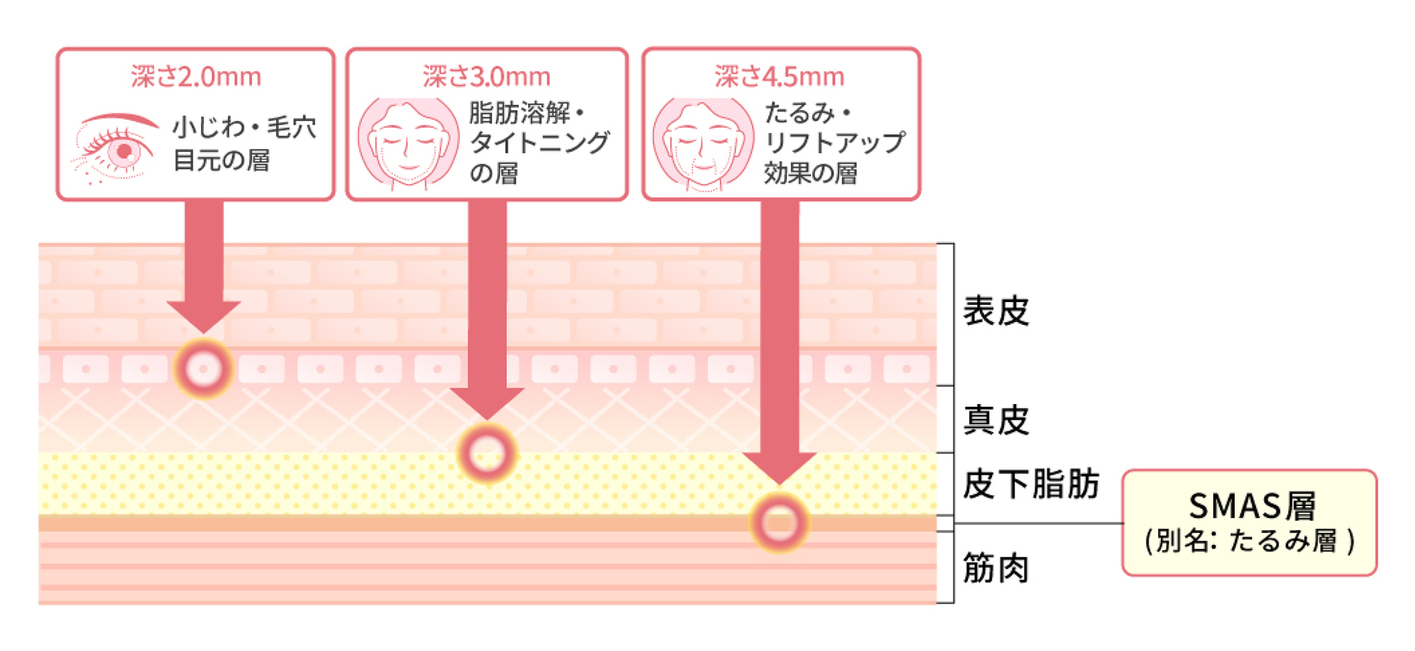 「yoniHIFU Ⅲ」は豊富なカートリッジでお悩みに合わせてアプローチ