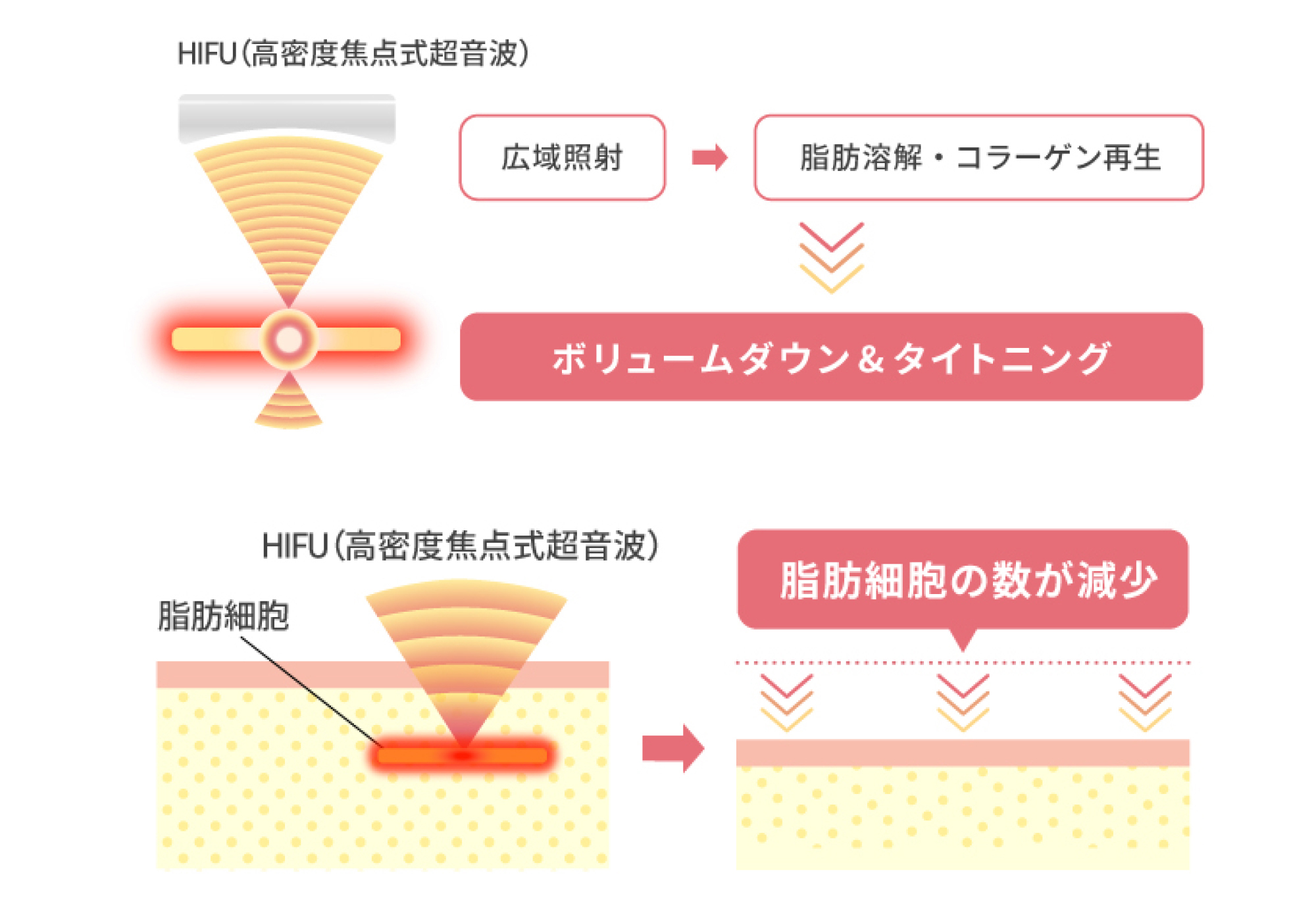 脂肪溶解ハイフとは？