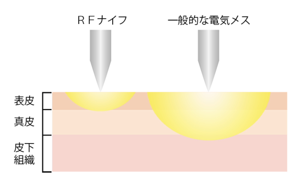 高周波ラジオ派メス（サージトロン：RFナイフ）とは