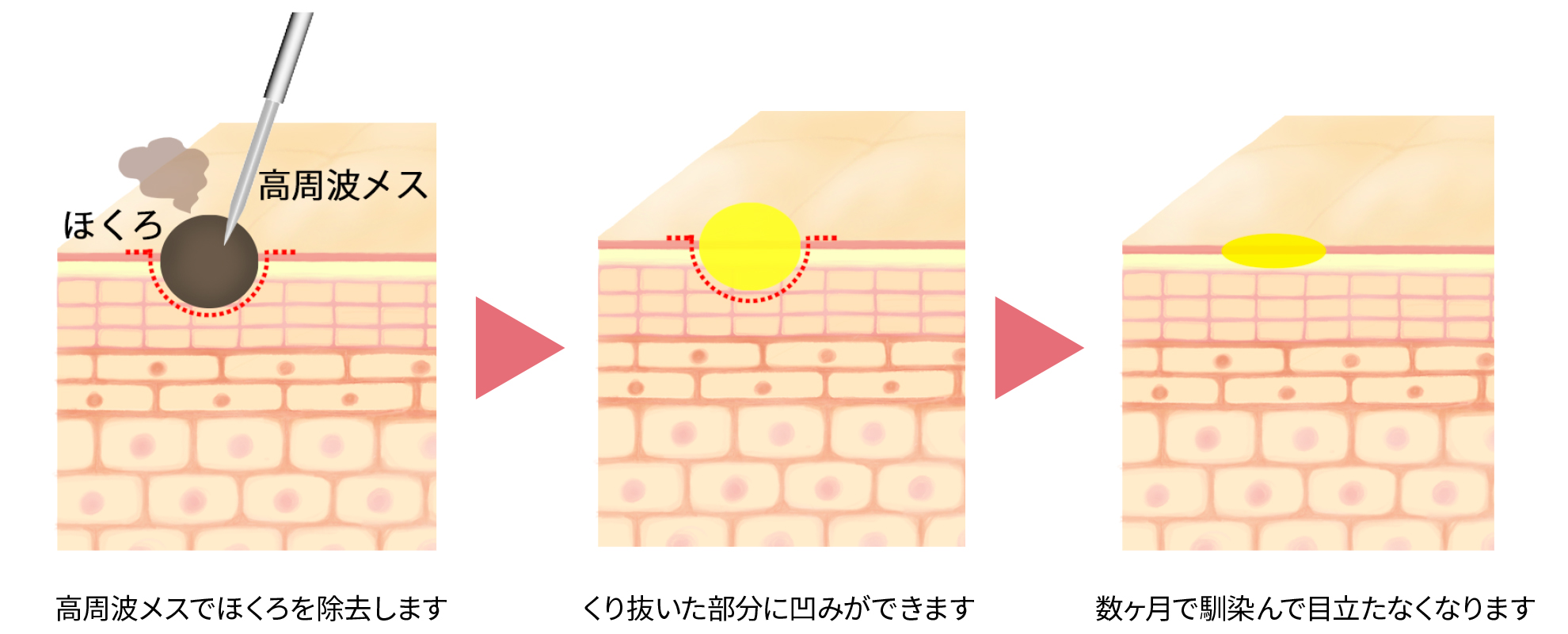 高周波ラジオ派メス