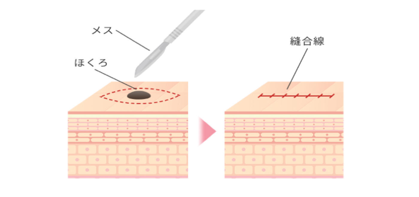 切開法とは