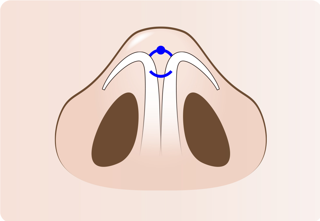 ④鼻翼軟骨同士をまとめるように結び、鼻先の形を細くします。
