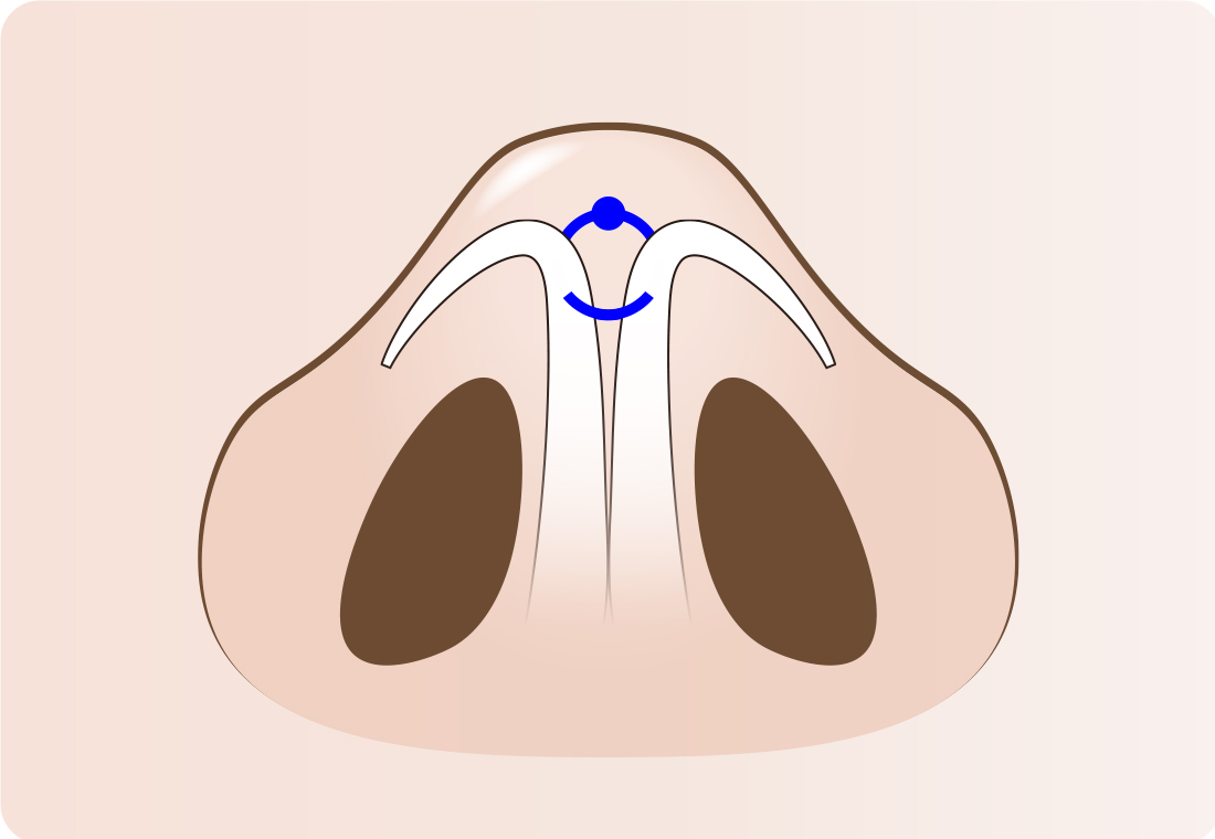 ④左右の軟骨を締めるように結び、鼻先の形を整えて傷口を縫合します。