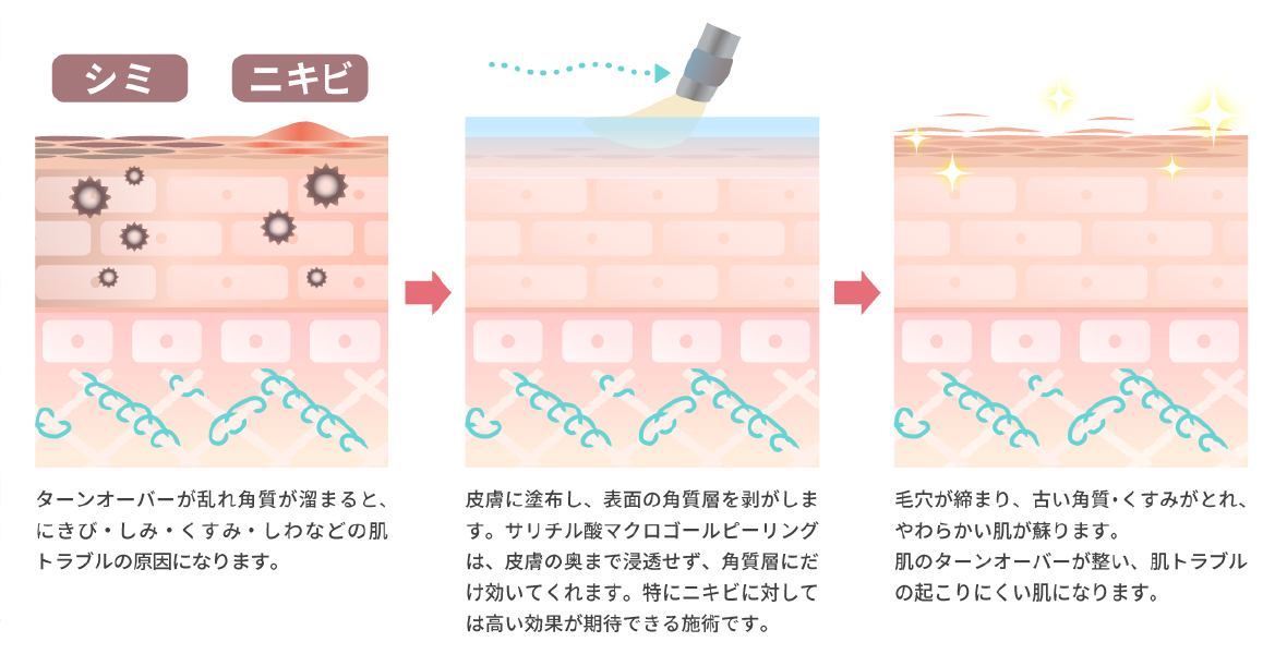 サリチル酸ピーリング（サリチル酸マクロゴールピーリング