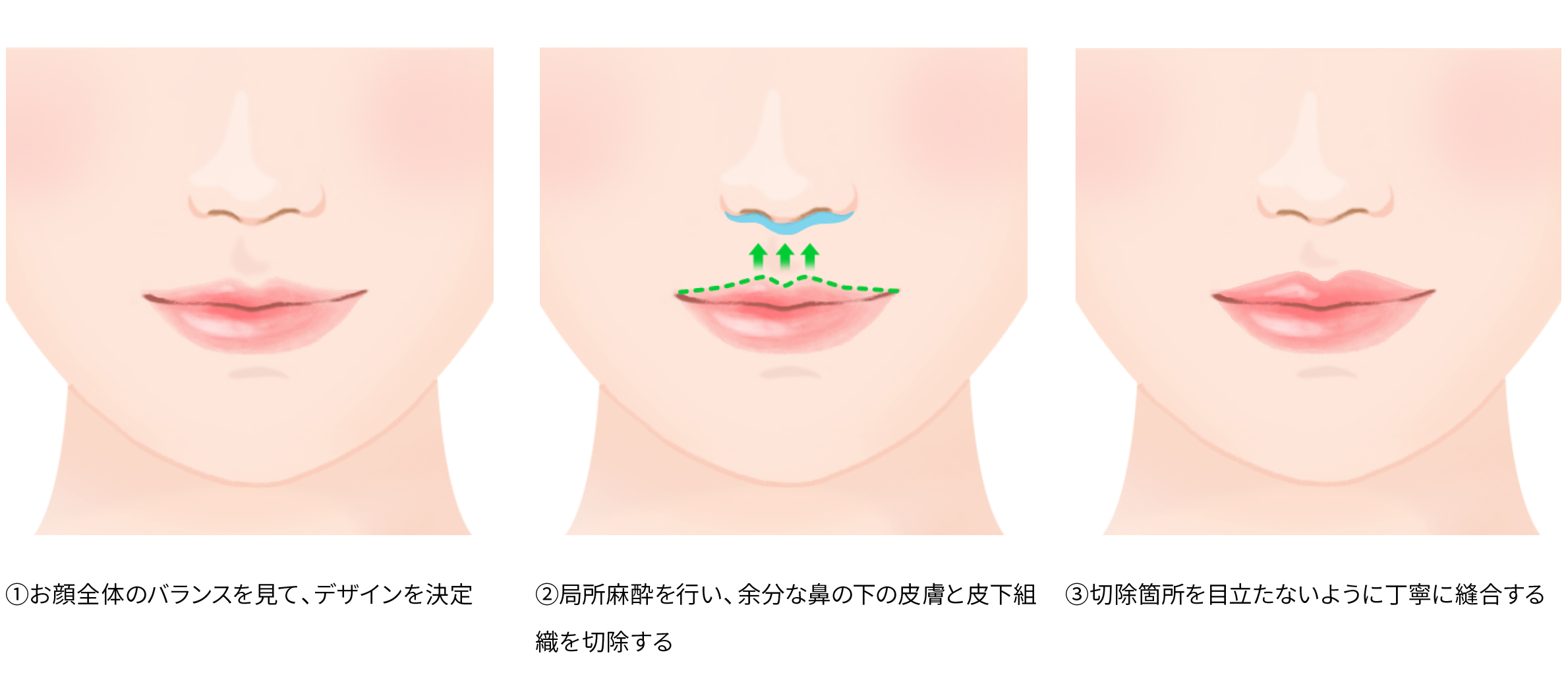 人中短縮術の施術方法