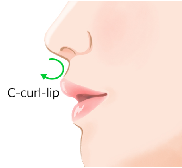 Cカールリップ（唇のヒアルロン酸注射）