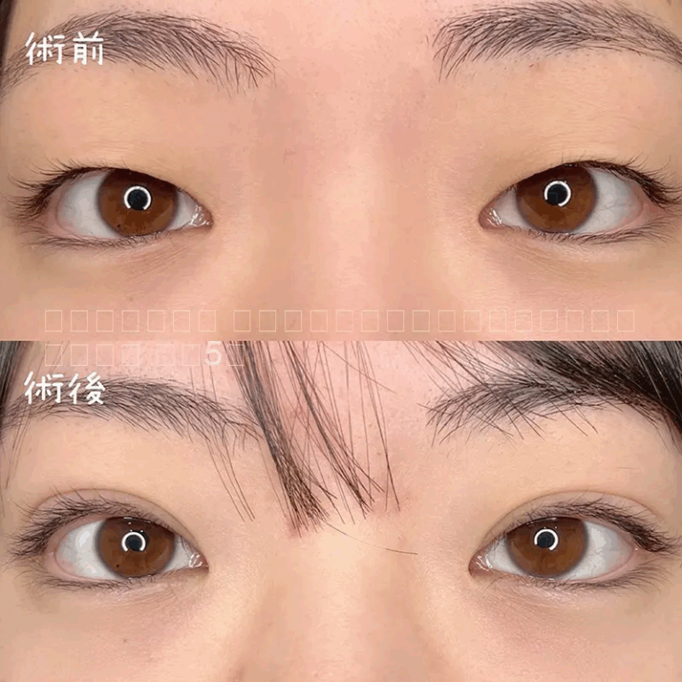 二重埋没法の症例写真