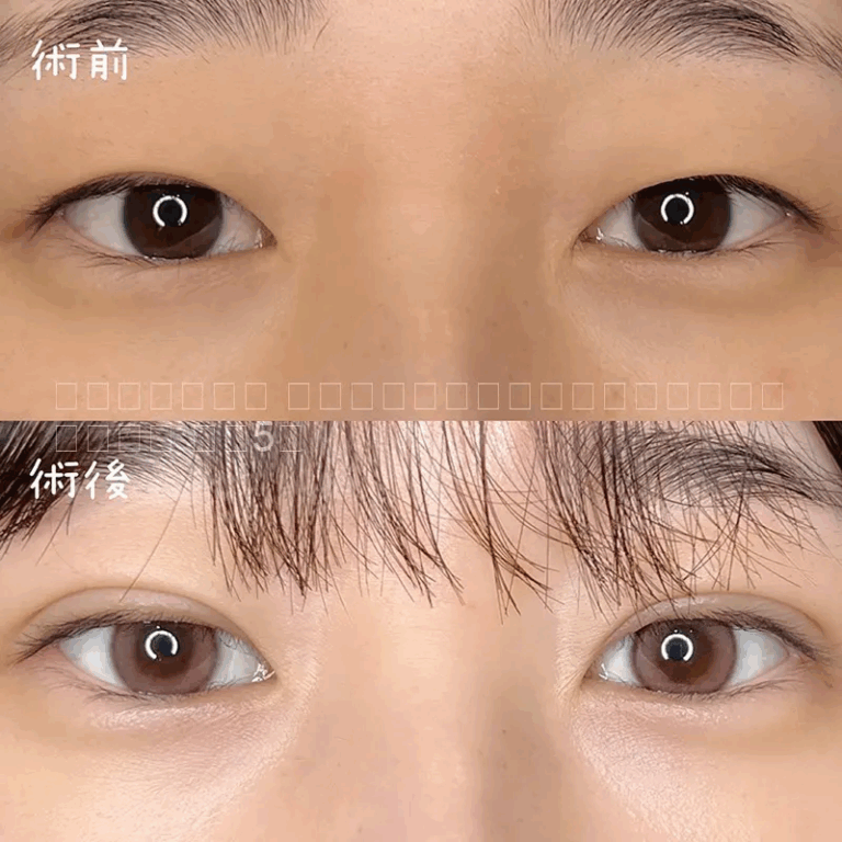 二重埋没法の症例写真