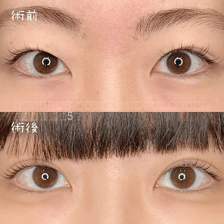 二重埋没法の症例写真