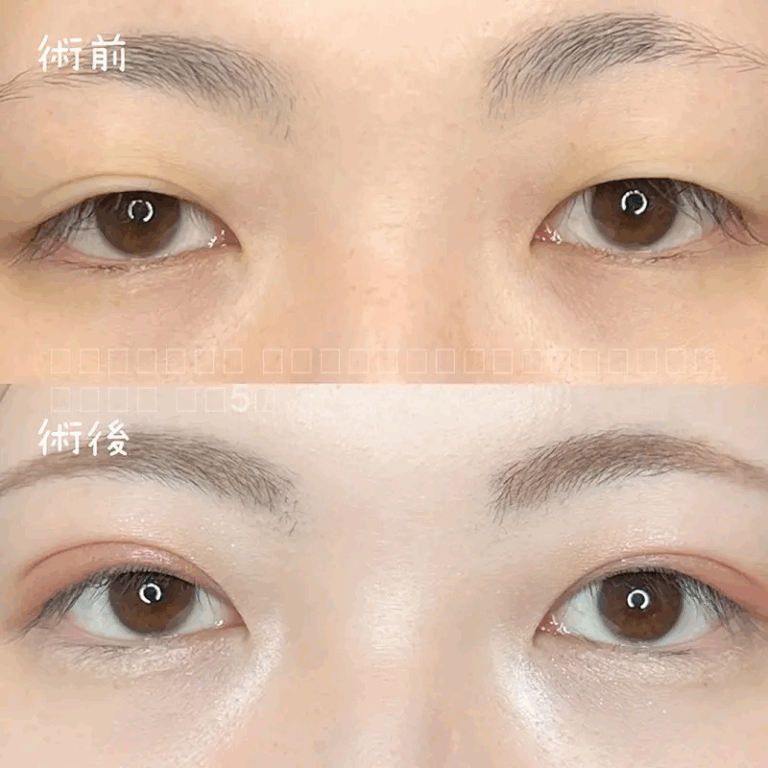 二重埋没法の症例写真
