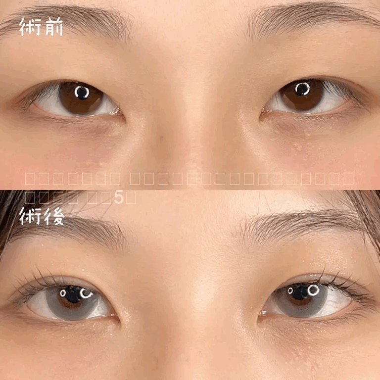 二重埋没法の症例写真