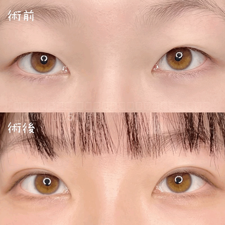 二重埋没法の症例写真