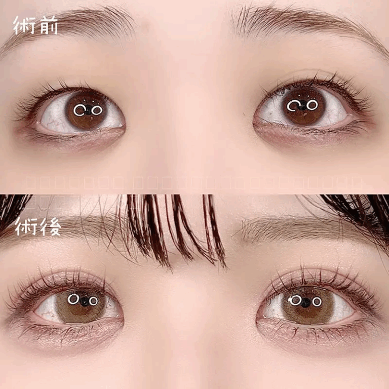 二重埋没法の症例写真