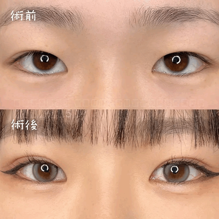二重埋没法の症例写真