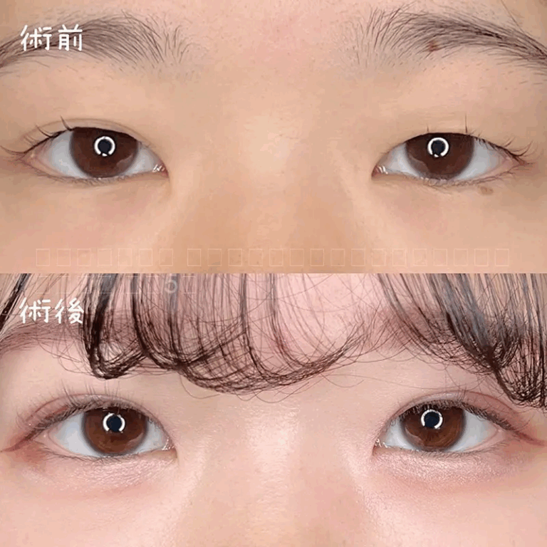 二重埋没法の症例写真
