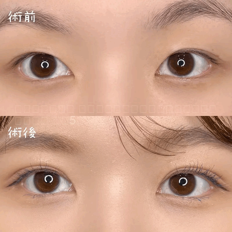 二重埋没法の症例写真