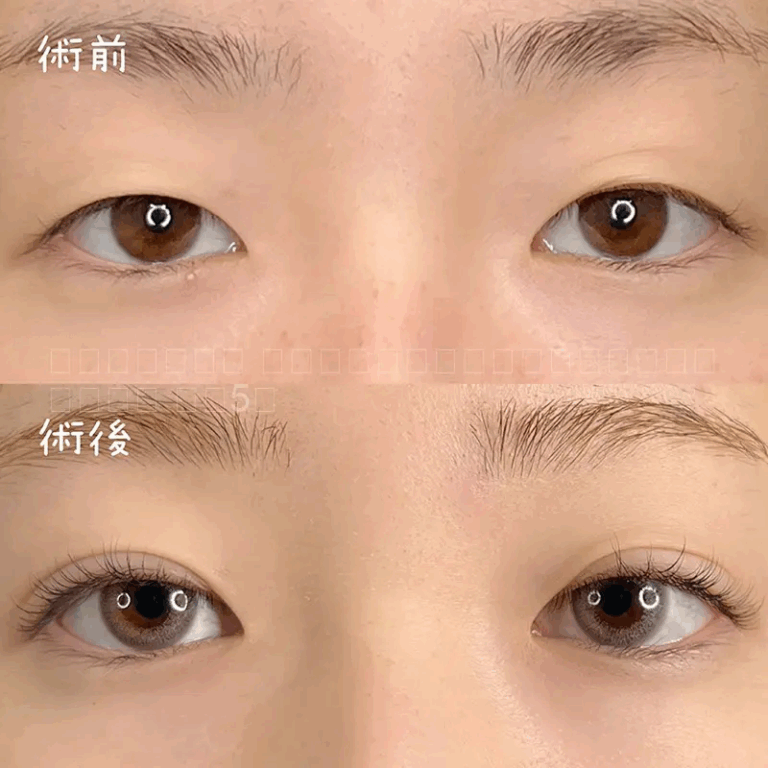 二重埋没法の症例写真