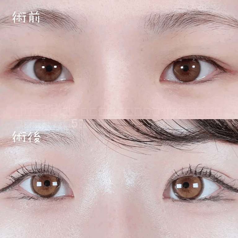二重埋没法の症例写真