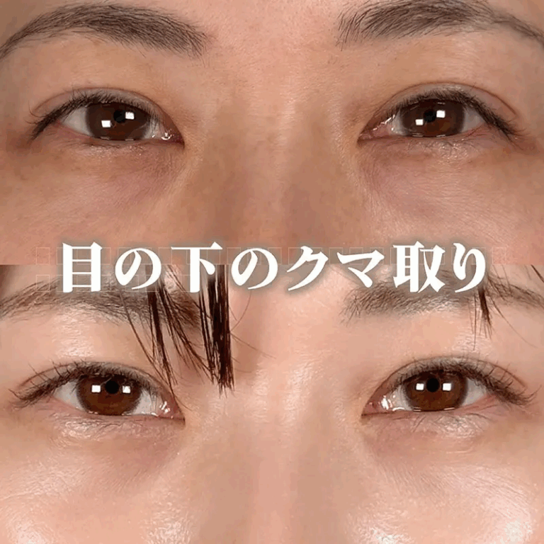 切らないクマ取りの症例写真