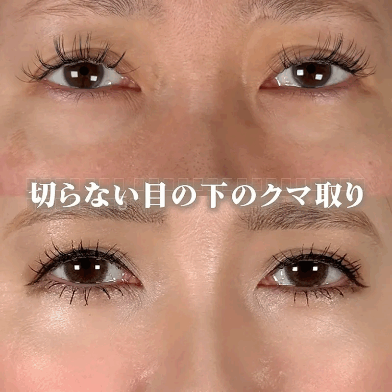 切らないクマ取りの症例写真