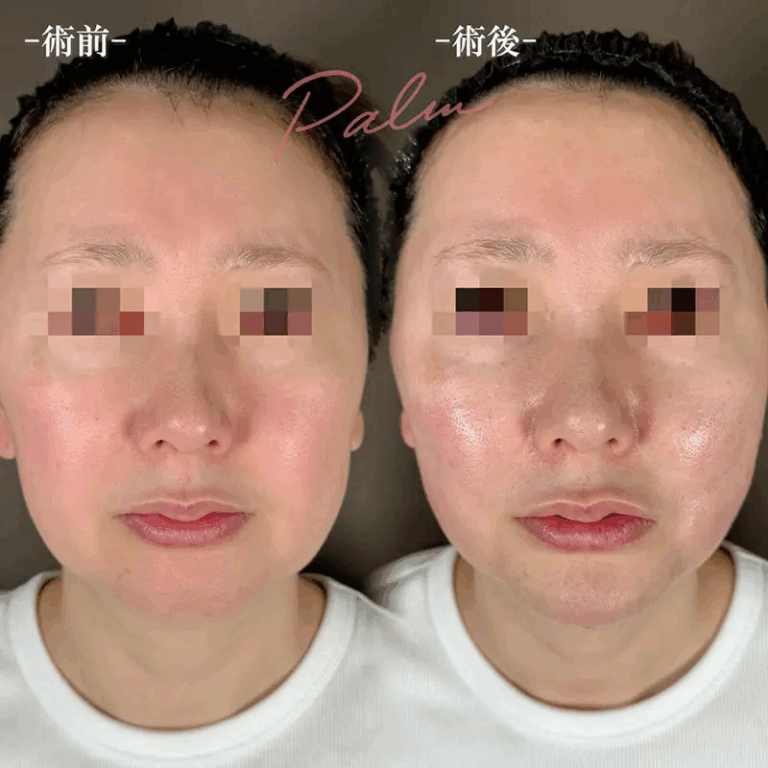糸リフトの症例写真