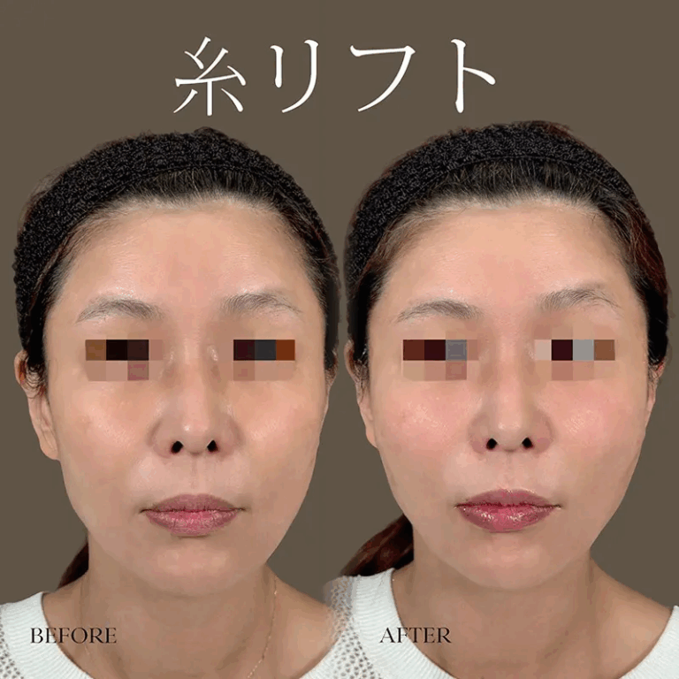 糸リフトの症例写真