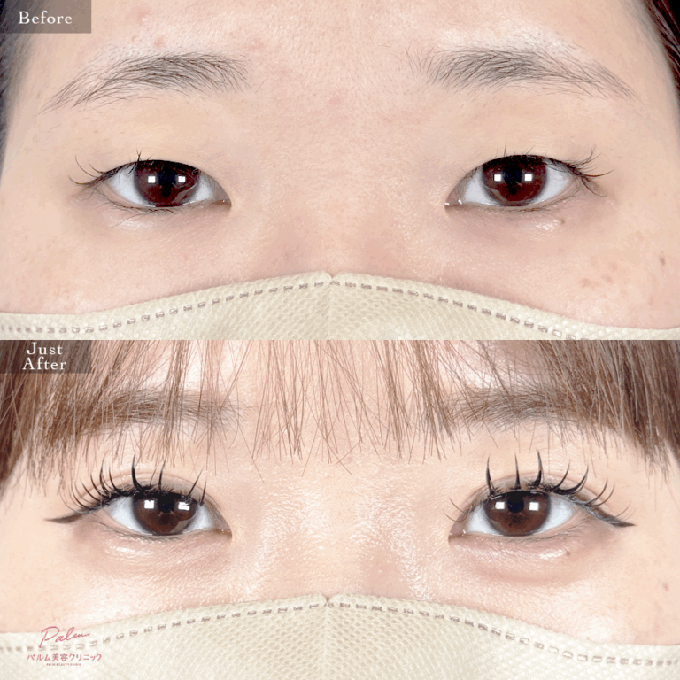 二重埋没法の症例写真