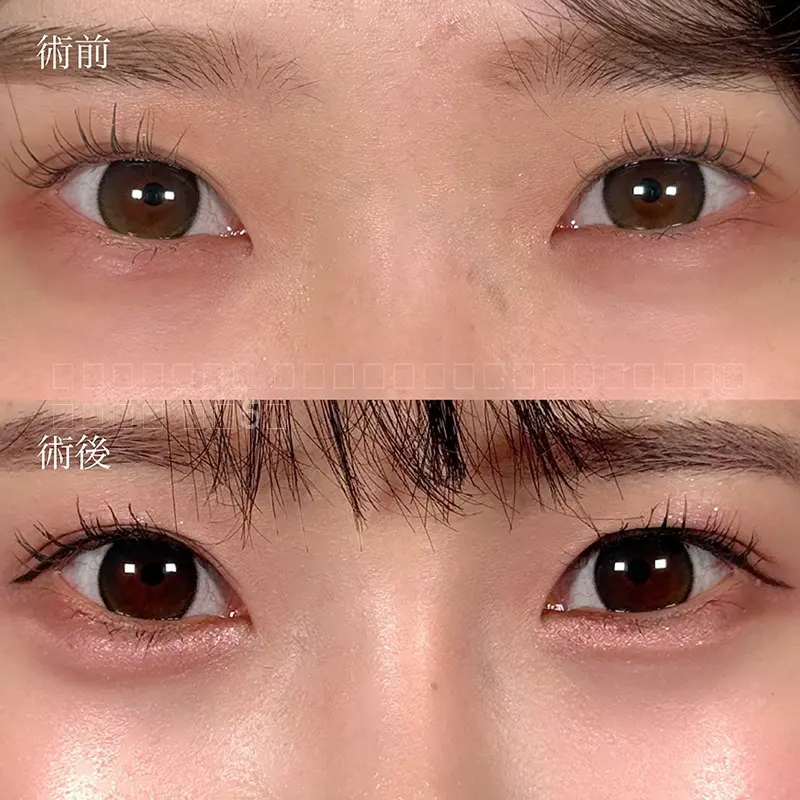 下瞼の裏側を小切開して、クマの原因の眼窩脂肪を一部除去することで、クマを改善します