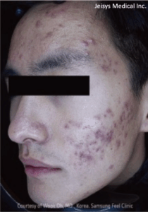 ニキビ治療（3回）