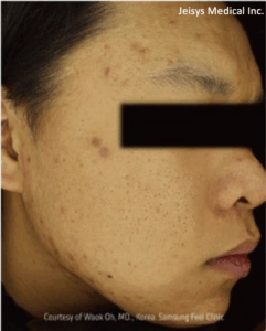 ニキビ跡治療（2回）