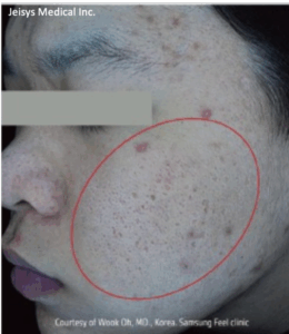 毛穴治療（2回）