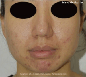 ニキビ治療（3回）