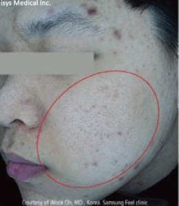 毛穴治療（2回）