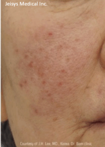 酒さ治療（3回）