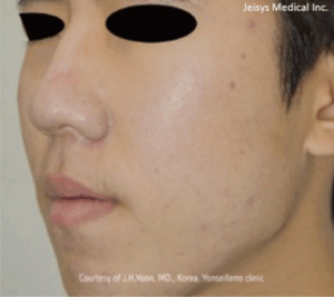 ニキビ治療 （1回）