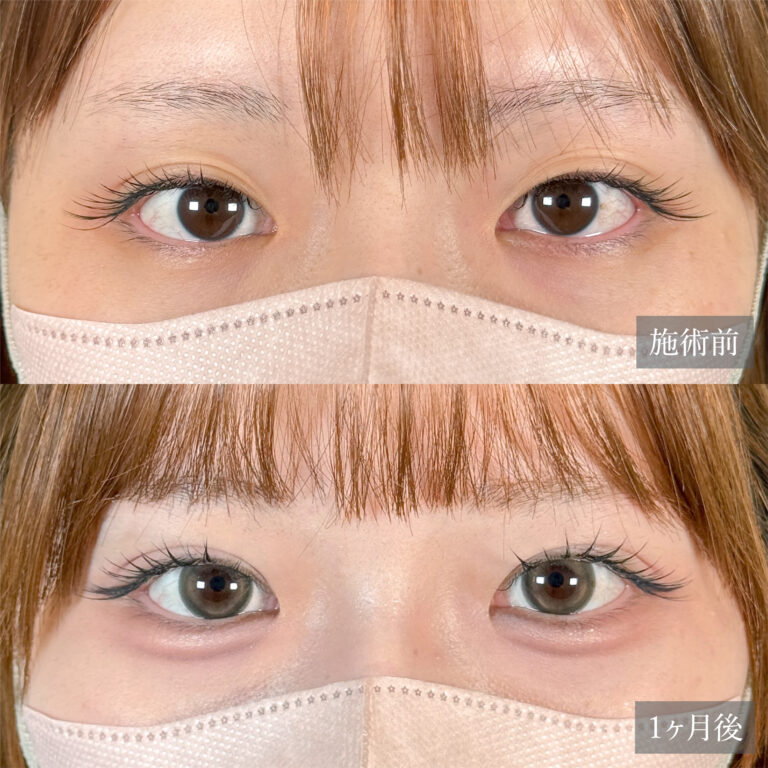 二重埋没法の症例写真