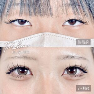 二重埋没法の症例写真3