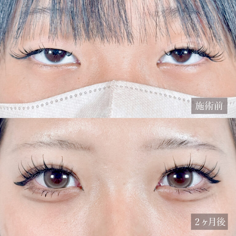 二重埋没法の症例写真