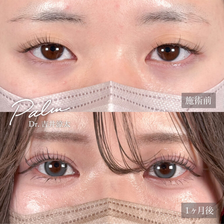 二重埋没法の症例写真