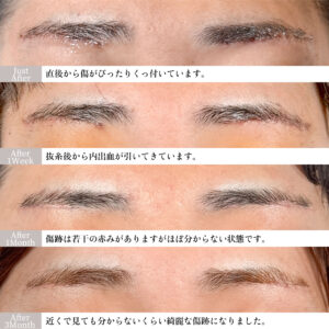 眉下切開（眉下リフト）の症例写真3