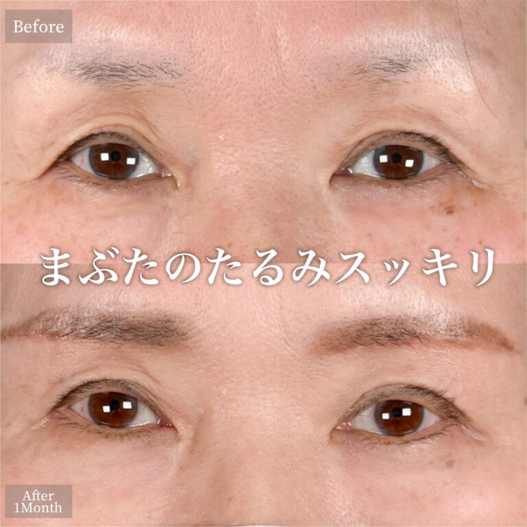 眉下切開（眉下リフト）の症例写真