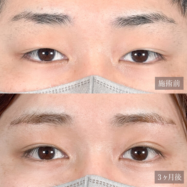 眉下切開（眉下リフト）の症例写真