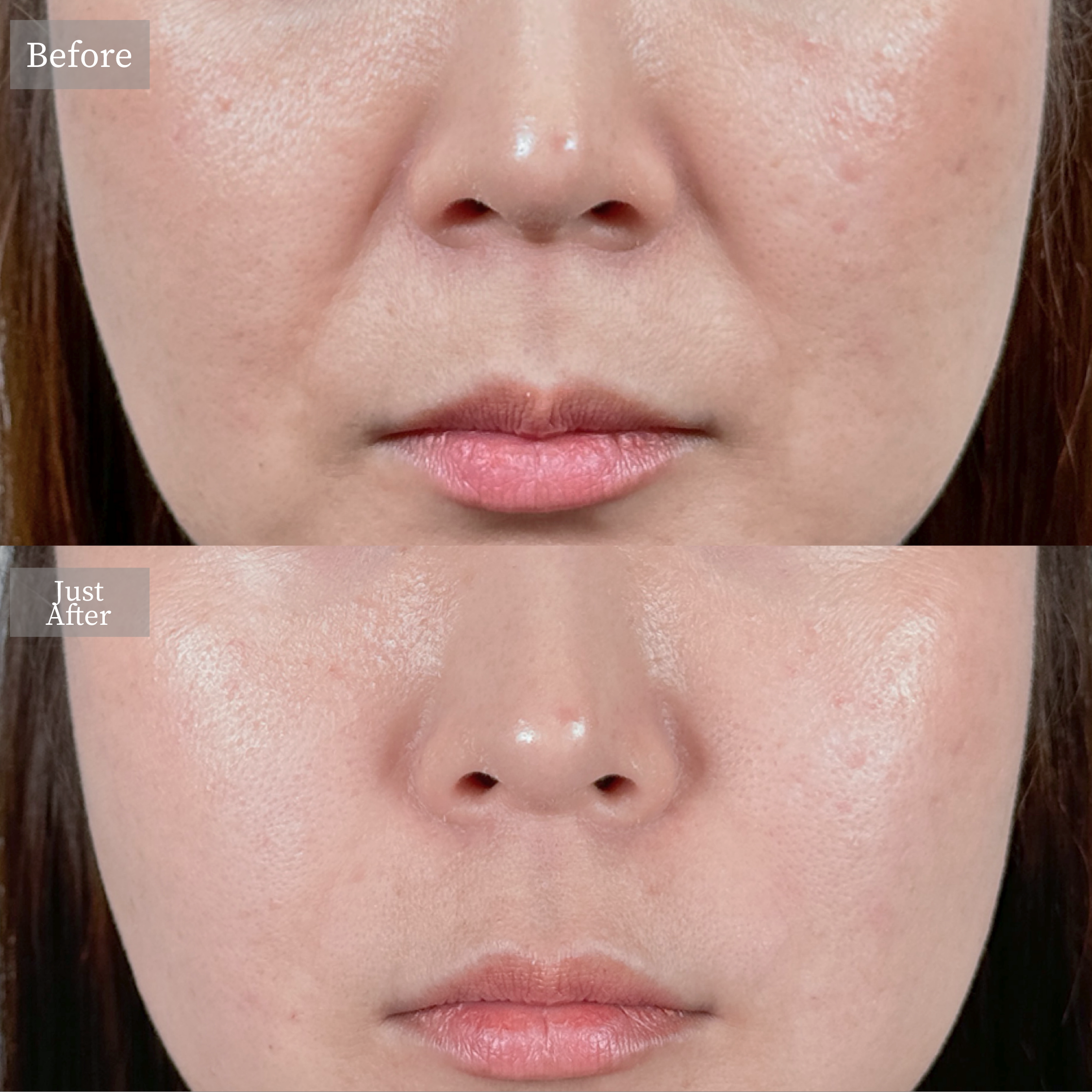 ヒアルロン酸注射（ほうれい線）