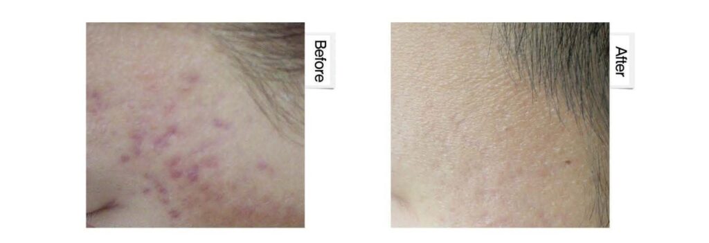 ケアシス(エレクトロポレーション)赤みの症例