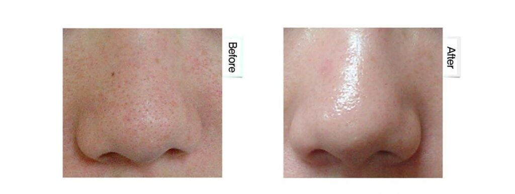 ケアシス(エレクトロポレーション)毛穴・キメの症例(鼻周囲)