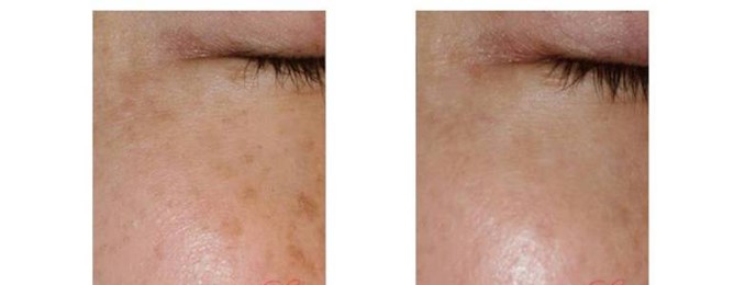 ケアシス(エレクトロポレーション)シミ治療後の肌質改善症例