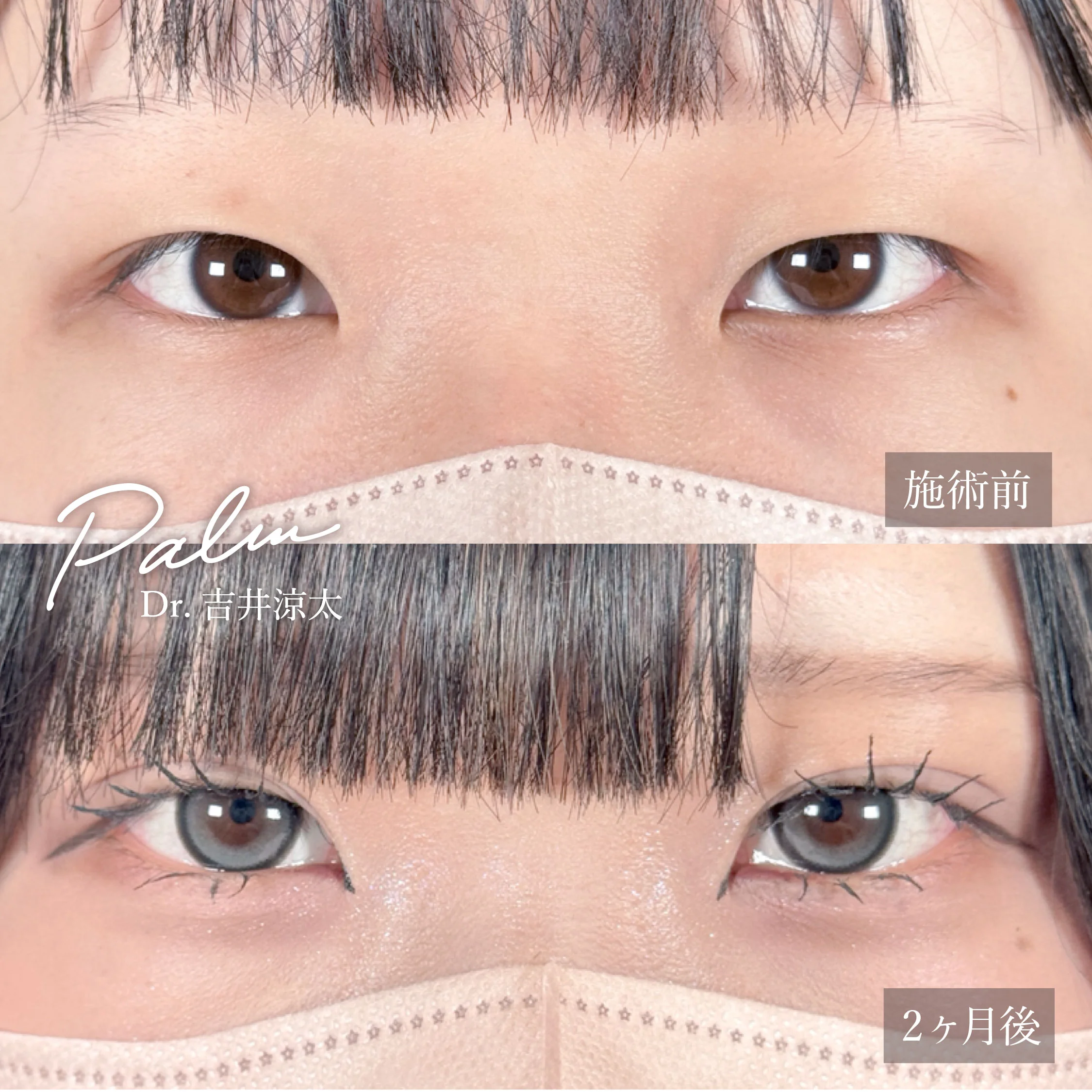 二重埋没法 症例写真①