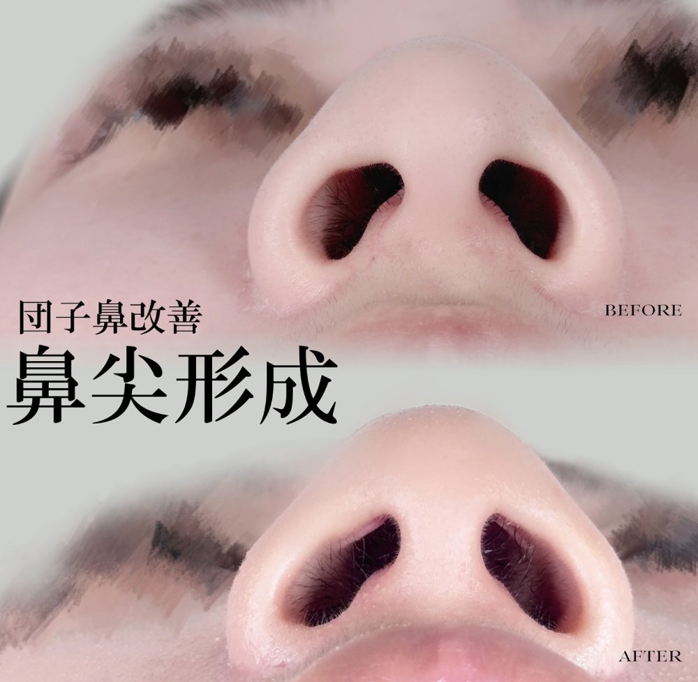 鼻尖形成の症例写真（施術前・施術後）
